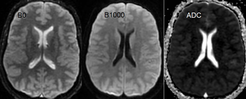 diffuse anoxic injury